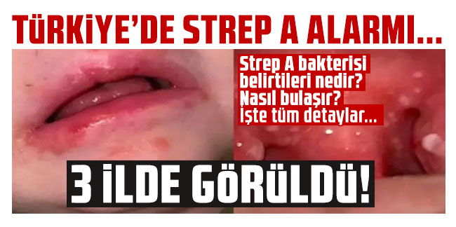 Türkiye'de Strep A alarmı... 3 ilde görüldü!