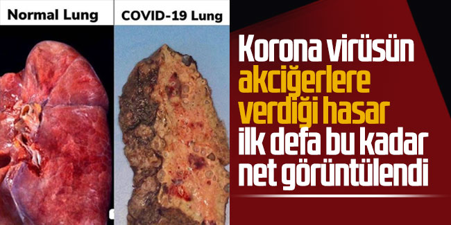 Korona virüsün akciğerlere verdiği hasar ilk defa bu kadar net görüntülendi
