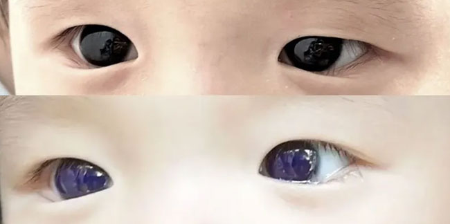 Covid-19 tedavisinde gözünün rengi değişti
