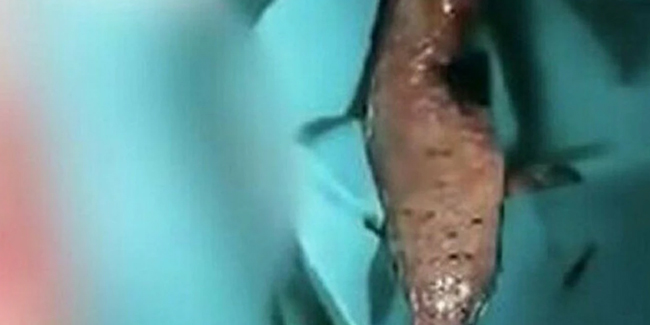 Makatına 40 santimlik balık kaçan vatandaş ameliyata alındı