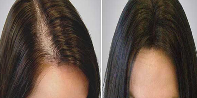Saç dökülmesi kadınları da etkiliyor 
