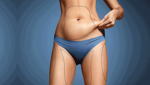 Liposuction hakkında bilmeniz gerekenler